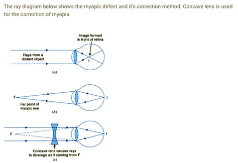 myopia can be corrected by using a.
